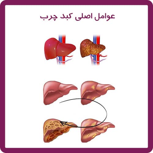 علل اصلی کبد چرب